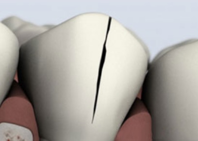Treatable Cracked Tooth