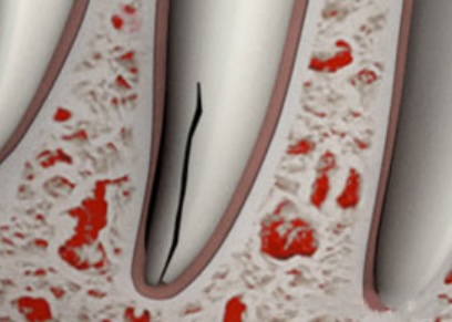 Vertical Root Fracture